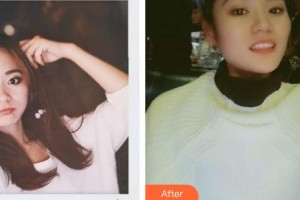 福州格萊美醫(yī)療美容醫(yī)院李志杰整形價格表附瓷貼面案例展示