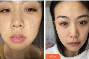 福州臺江醫(yī)院整形美容中心潘桂蘭整形價格表附激光美膚祛斑案例展示