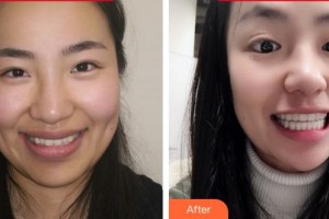 福州維樂口腔門診部郭淑蘋整形價格表附隱形矯正案例展示