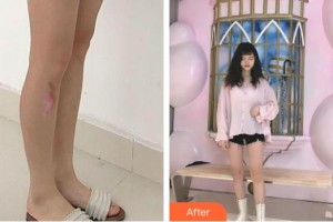 福州愛美爾整形美容醫(yī)院張洪濤整形價格表附增生疤痕案例展示