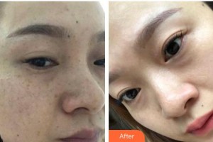 福州臺江醫(yī)院整形美容中心黃富梅整形價格表附雙激光美膚案例展示