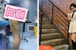 福州格萊美醫(yī)療美容醫(yī)院米契爾.高德曼整形價格表附吸脂案例展示