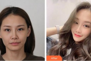 福州名韓整形美容醫(yī)院李陽(yáng)整形價(jià)格表附DA·面部脂肪填充案例展示