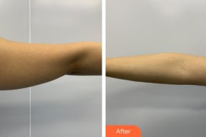 福州格萊美醫(yī)療美容醫(yī)院陳陽(yáng)整形價(jià)格表附手臂吸脂案例展示