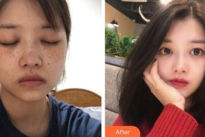 福州臺(tái)江醫(yī)院整形美容中心李江麗整形價(jià)格表附激光美膚案例展示