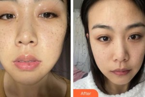 福州愛(ài)思特醫(yī)療美容醫(yī)院李宏整形價(jià)格表附超激光美膚祛斑案例展示