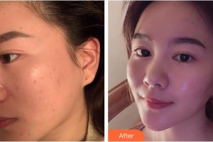 福州華窈渙美整形美容醫(yī)院林伯瀅整形價(jià)格表附激光美膚激光案例展示