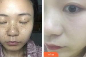 福州愛(ài)思特比華利整形美容醫(yī)院李燕華整形價(jià)格表附超激光美膚祛斑案例展示