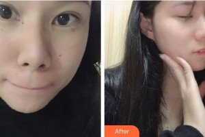 福州愛(ài)思特比華利整形美容醫(yī)院嚴(yán)玉秀整形價(jià)格表附雙激光美膚案例展示