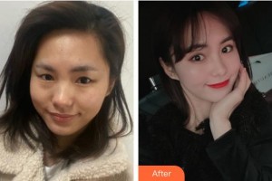 福州華窈渙美整形美容醫(yī)院黃演首整形價(jià)格表附眼部整形案例展示