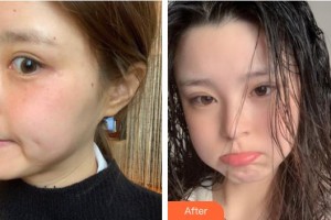 福州市第八人民醫(yī)院整形美容科羅莉整形價(jià)格表附激光美膚激光案例展示