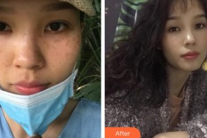 福州華窈渙美整形美容醫(yī)院劉麗麗整形價(jià)格表附祛斑案例展示