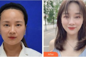 福州市第八人民醫(yī)院整形美容科索南多杰整形價(jià)格表附埋線(xiàn)提升案例展示