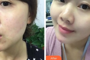 福州市第八人民醫(yī)院整形美容科潘潔整形價(jià)格表附激光美膚祛斑案例展示