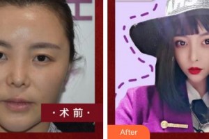 福州名韓整形美容醫(yī)院宋潤(rùn)相整形價(jià)格表附鼻部手術(shù)案例展示