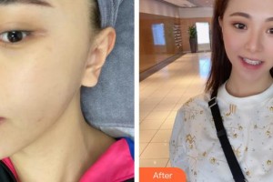 福州市鼓樓醫(yī)院整形美容中心鄭春燕整形價(jià)格表附激光祛斑案例展示