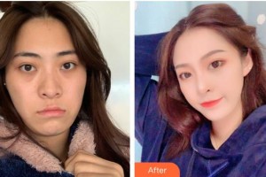 福州匯美整形美容醫(yī)院游家偉整形價(jià)格表附抗衰老案例展示