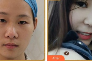 福州市第一醫(yī)院整形美容科郭國(guó)祥整形價(jià)格表附眼部多項(xiàng)案例展示