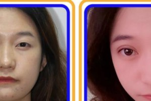 福州市第八人民醫(yī)院整形美容科陳雄整形價(jià)格表附眼部綜合案例展示