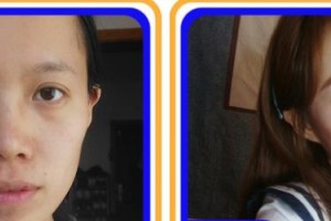 福州藝美醫(yī)療整形美容診所廖國(guó)良整形價(jià)格表附眼部手術(shù) 案例展示