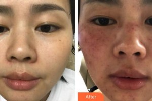 福州藝美醫(yī)療整形美容診所何卉整形價(jià)格表附超激光美膚案例展示