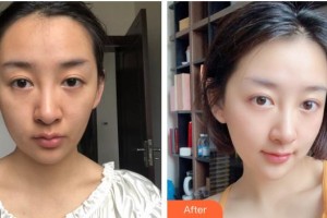 福州美貝爾醫(yī)療美容門(mén)診部姍整形價(jià)格表附埋線(xiàn)提升提升案例展示