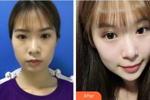 福州市第八人民醫(yī)院整形美容科柴天舉整形價(jià)格表附埋線(xiàn)提升案例展示