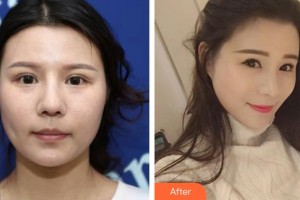 福州藝美醫(yī)療整形美容診所張艷整形價(jià)格表附四代熱瑪吉案例展示