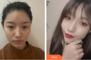 福州市第八人民醫(yī)院整形美容科談偉佳整形價(jià)格表附發(fā)際線(xiàn)種植案例展示