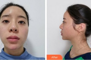 福州海峽美容醫(yī)院羅杰東整形價(jià)格表附眼部案例展示