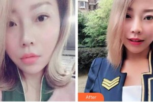 福州新時(shí)代醫(yī)療美容門診部肖逸整形價(jià)格表附牙齒隱形矯正案例展示