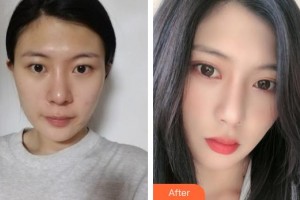 福州新時(shí)代醫(yī)療美容門診部都彥祿整形價(jià)格表附眼部案例展示