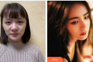 福州海峽美容醫(yī)院何俊杰整形價(jià)格表附肋軟骨隆鼻案例展示