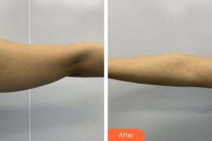 福州海峽美容醫(yī)院蔡玉蕊整形價(jià)格表附吸脂案例展示