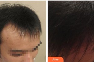 福州格萊美醫(yī)療美容醫(yī)院高欣整形價格表附植發(fā)案例展示