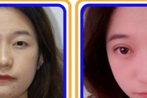 福州美貝爾醫(yī)療美容門診部薛欣整形價(jià)格表附眼部綜合案例展示