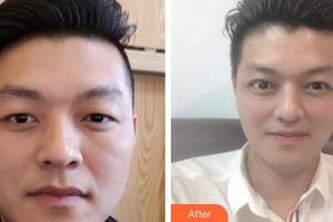 福州美貝爾醫(yī)療美容門診部張曉棠整形價(jià)格表附即變男神，無關(guān)痛癢案例展示