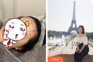 福州格萊美醫(yī)療美容醫(yī)院張鳳整形價(jià)格表附抗皺案例展示