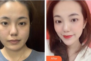 福州格萊美醫(yī)療美容醫(yī)院曹泓整形價(jià)格表附抗衰案例展示