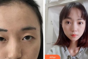 福州名韓整形美容醫(yī)院察鵬飛整形價格表附雙眼皮案例展示