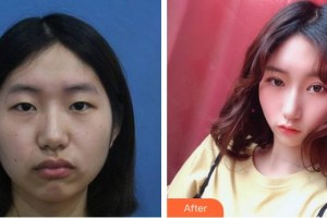 福州名韓整形美容醫(yī)院林偉整形價格表附美眼部手術案例展示