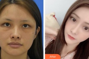 福州格萊美醫(yī)療美容醫(yī)院徐麗麗整形價格表附抗衰老案例展示