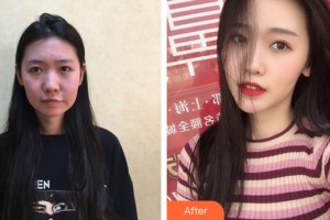 福州市鼓樓醫(yī)院整形美容中心張睅理整形價格表附埋線提升手術案例展示