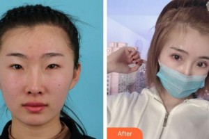 福州眼科醫(yī)院李青整形價(jià)格表附雙眼皮案例展示