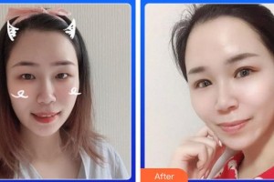 福州眼科醫(yī)院程金輝整形價(jià)格表附眼部手術(shù)案例展示