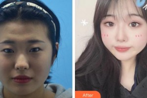 福州眼科醫(yī)院胡穎峰整形價(jià)格表附眼部整形案例展示