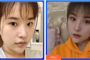 福州眼科醫(yī)院吳景華整形價格表附眼部綜合案例展示