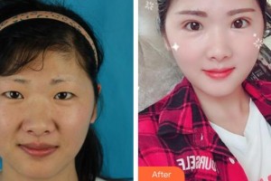 福州東南眼科醫(yī)院劉利娟整形價格表附切開雙眼皮案例展示
