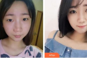 福州眼科醫(yī)院鄭玉炎整形價格表附自然雙眼皮案例展示
