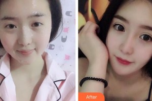 福州東南眼科醫(yī)院趙廣愚整形價格表附雙眼皮+開內(nèi)眼角案例展示